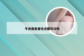 牛皮癣患者吃点醋可以吗