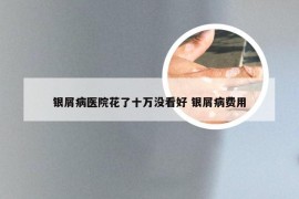 银屑病医院花了十万没看好 银屑病费用