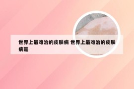 世界上最难治的皮肤病 世界上最难治的皮肤病是