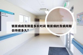 银屑病病发期是多长时间 银屑病的发病周期会持续多久?