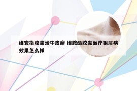 维安指胶囊治牛皮癣 维胺酯胶囊治疗银屑病效果怎么样