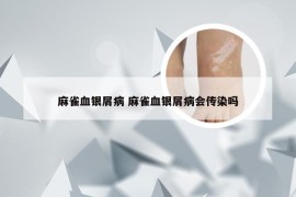 麻雀血银屑病 麻雀血银屑病会传染吗