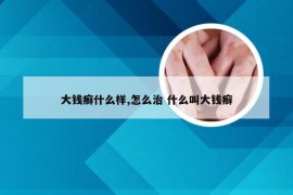 大钱癣什么样,怎么治 什么叫大钱癣