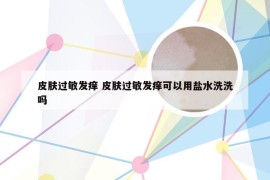 皮肤过敏发痒 皮肤过敏发痒可以用盐水洗洗吗