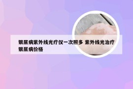 银屑病紫外线光疗仪一次照多 紫外线光治疗银屑病价格