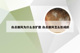 白点癫风为什么会扩散 白点癫风怎么形成的