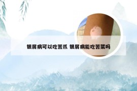 银屑病可以吃苦爪 银屑病能吃苦菜吗