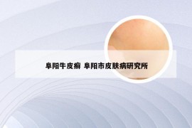 阜阳牛皮癣 阜阳市皮肤病研究所