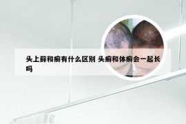 头上藓和癣有什么区别 头癣和体癣会一起长吗