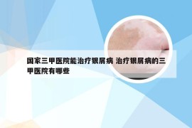 国家三甲医院能治疗银屑病 治疗银屑病的三甲医院有哪些