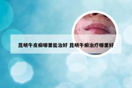 昆明牛皮癣哪里能治好 昆明牛癣治疗哪里好