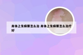 身体上生癣要怎么治 身体上生癣要怎么治疗好
