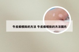 牛皮癣根除的方法 牛皮癣根除的方法图片