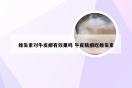 维生素对牛皮癣有效果吗 牛皮肤癣吃维生素