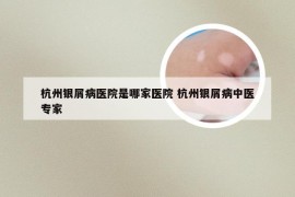 杭州银屑病医院是哪家医院 杭州银屑病中医专家