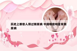历史上那些人得过银屑病 中国哪些明星有银屑病