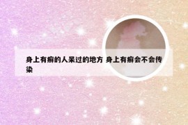 身上有癣的人呆过的地方 身上有癣会不会传染