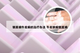银屑病牛皮癣的治疗办法 牛皮肤癣银屑病