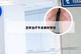 怎样治疗牛皮癣好得快