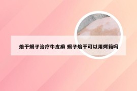 焙干蝎子治疗牛皮癣 蝎子焙干可以用烤箱吗