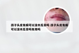 孩子头皮有癣可以涂木瓜膏吗 孩子头皮有癣可以涂木瓜膏吗有用吗