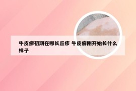牛皮癣初期在哪长丘疹 牛皮癣刚开始长什么样子