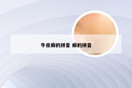 牛皮癣的拼音 癣的拼音