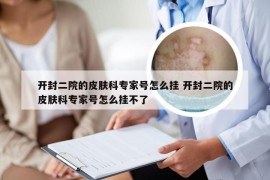 开封二院的皮肤科专家号怎么挂 开封二院的皮肤科专家号怎么挂不了