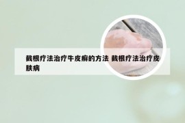 截根疗法治疗牛皮癣的方法 截根疗法治疗皮肤病