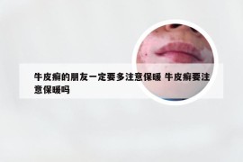 牛皮癣的朋友一定要多注意保暖 牛皮癣要注意保暖吗