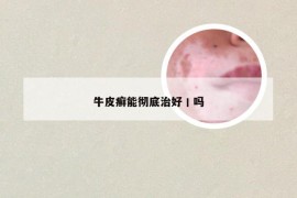 牛皮癣能彻底治好丨吗