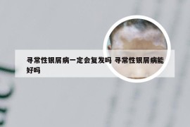 寻常性银屑病一定会复发吗 寻常性银屑病能好吗