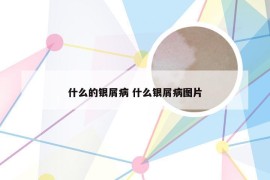 什么的银屑病 什么银屑病图片