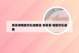 银屑病嗜酸性粒细胞值 银屑病 嗜酸性粒细胞