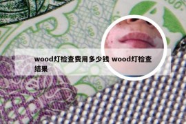 wood灯检查费用多少钱 wood灯检查结果