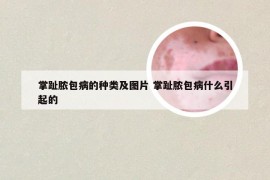 掌趾脓包病的种类及图片 掌趾脓包病什么引起的