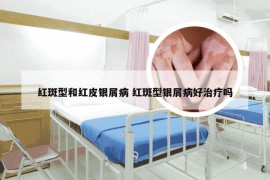 红斑型和红皮银屑病 红斑型银屑病好治疗吗