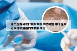 哪个医院可以打银屑病的生物制剂 哪个医院可以打银屑病的生物制剂药