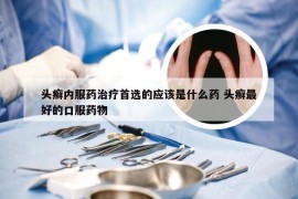 头癣内服药治疗首选的应该是什么药 头癣最好的口服药物