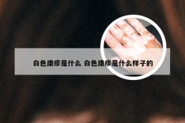 白色康疹是什么 白色康疹是什么样子的