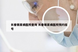 长春银屑病医院查询 长春银屑病医院预约挂号