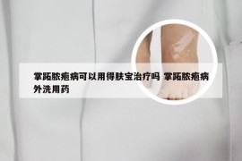 掌跖脓疱病可以用得肤宝治疗吗 掌跖脓疱病外洗用药