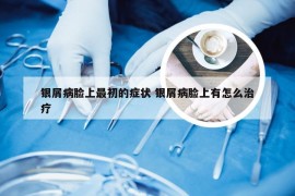 银屑病脸上最初的症状 银屑病脸上有怎么治疗