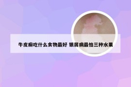 牛皮癣吃什么食物最好 银屑病最怕三种水果