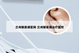 兰州银屑病官网 兰州银屑病治疗医院