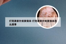 打完激素针皮肤变白 打完激素针皮肤变白怎么回事