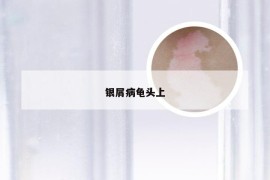 银屑病龟头上