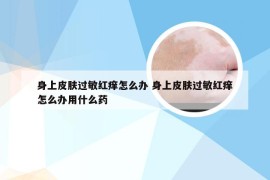 身上皮肤过敏红痒怎么办 身上皮肤过敏红痒怎么办用什么药