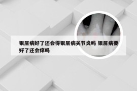 银屑病好了还会得银屑病关节炎吗 银屑病要好了还会痒吗