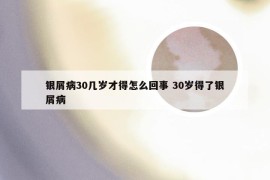 银屑病30几岁才得怎么回事 30岁得了银屑病